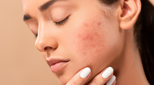 a young woman needing to manage rosacea on her cheeks