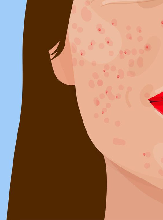 Cleansing 101 for Oily/Active/Combination Skins