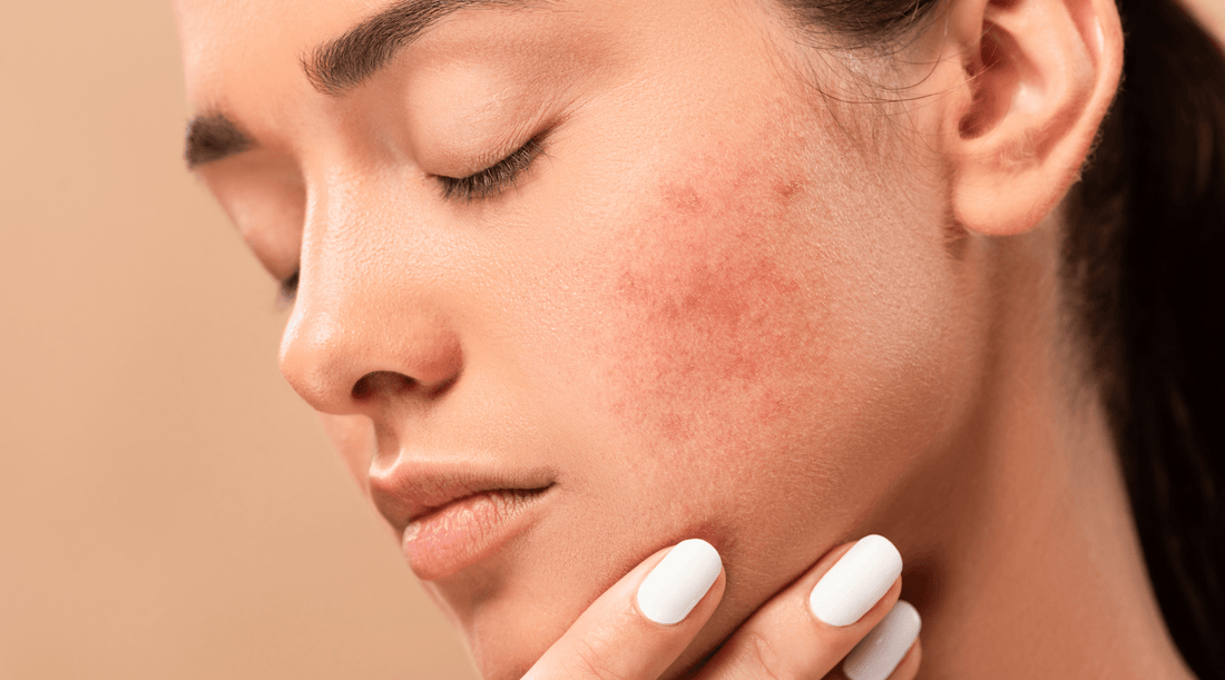 How To Manage Rosacea: 6 Simple, Skin Cooling Tips. - Australian Skin Institute