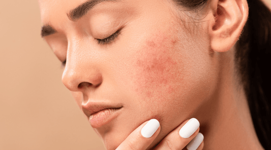 How To Manage Rosacea: 6 Simple, Skin Cooling Tips. - Australian Skin Institute