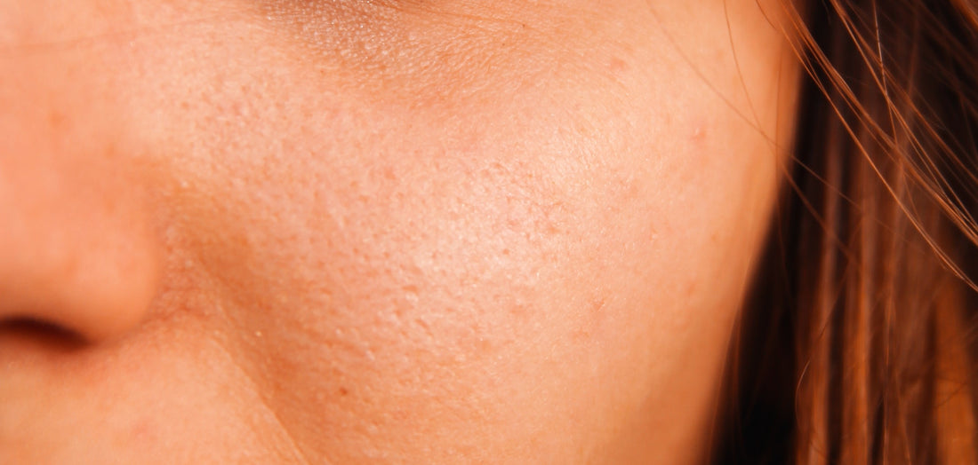 Skin Care Tips for Excess Sebum Production